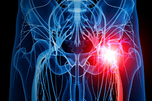 Sciatica -Licensed Massage Therapist